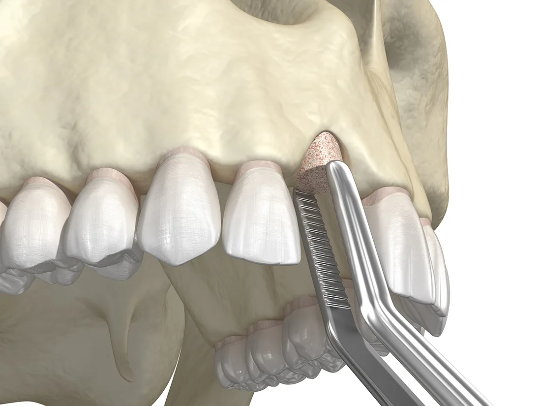 conover bone grafting and gbr